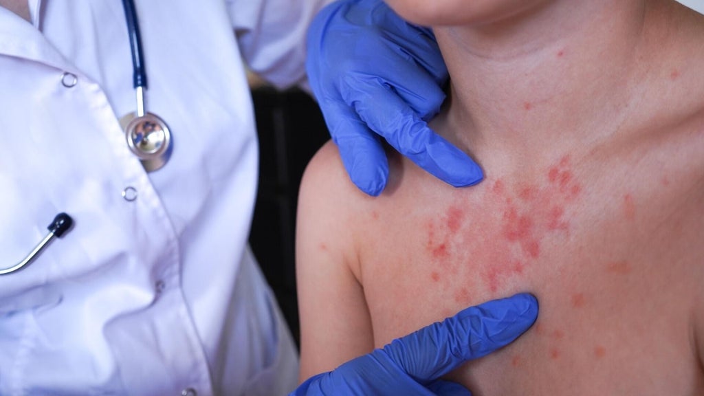 Minnesota's 80 measles cases this year are the most since 1990, health officials say — Lakeville Health news